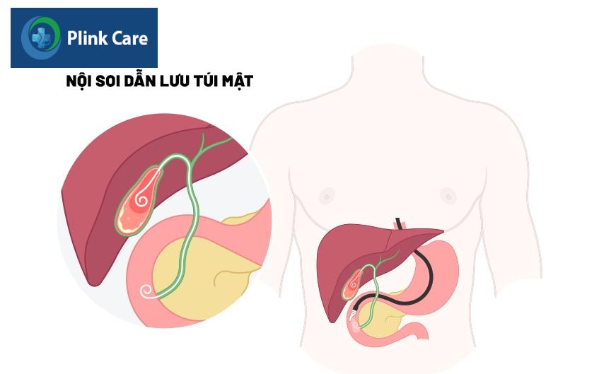 nội soi dẫn lưu túi mật