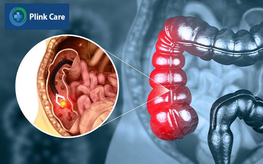 quy trình sinh thiết đại tràng