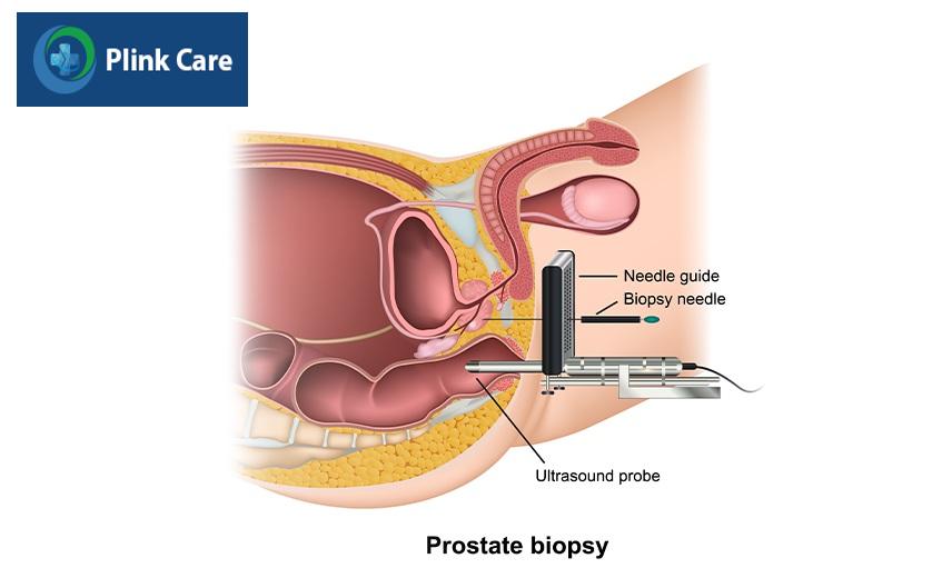 quy trình sinh thiết tuyến tiền liệt