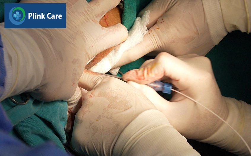 tia laser chữa trĩ