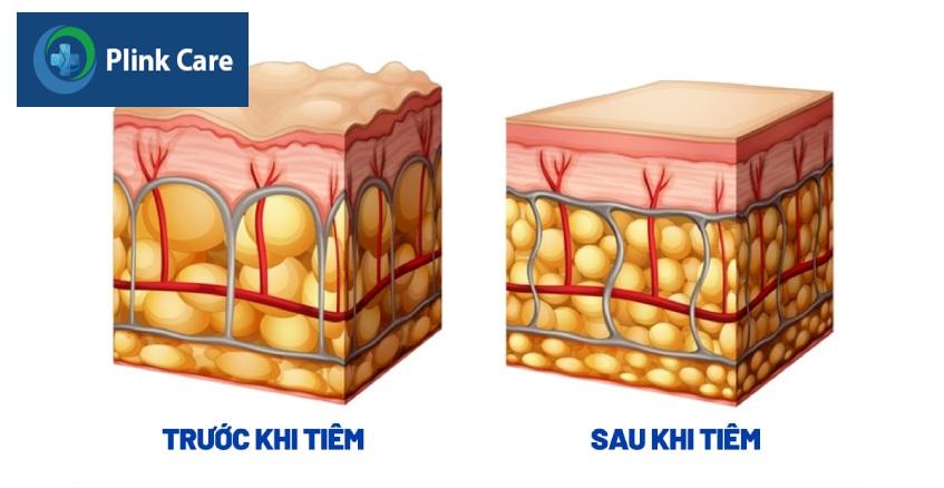 bề mặt da trước và sau tiêm filler