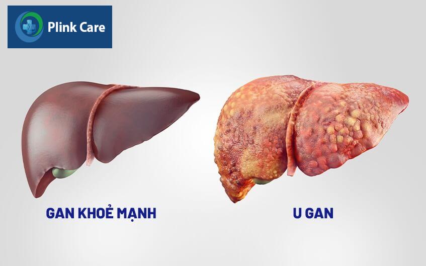 bệnh ung thư gan giai đoạn đầu