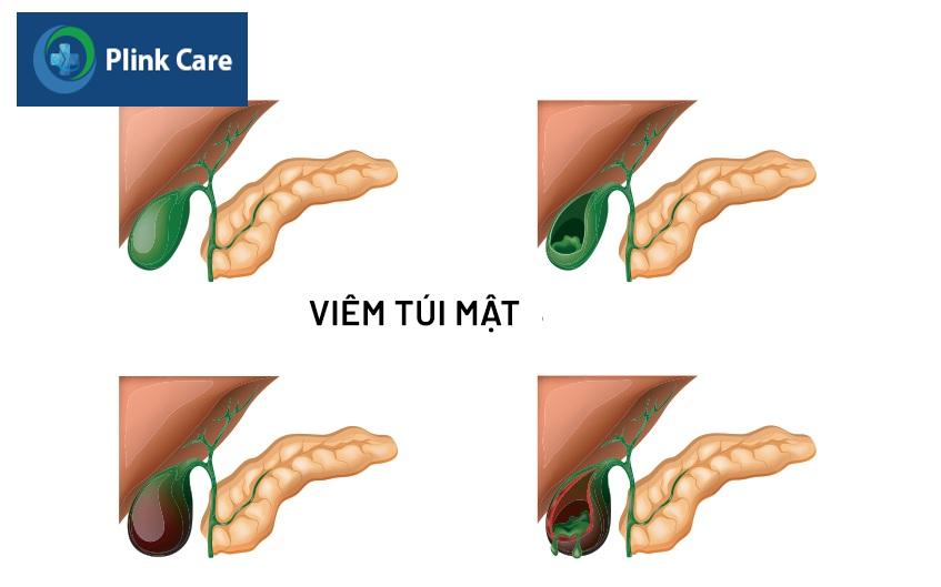 bị viêm túi mật