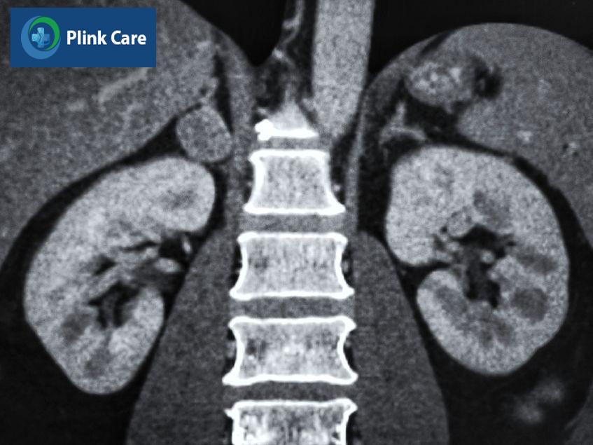ct thận ứ nước chính xác không