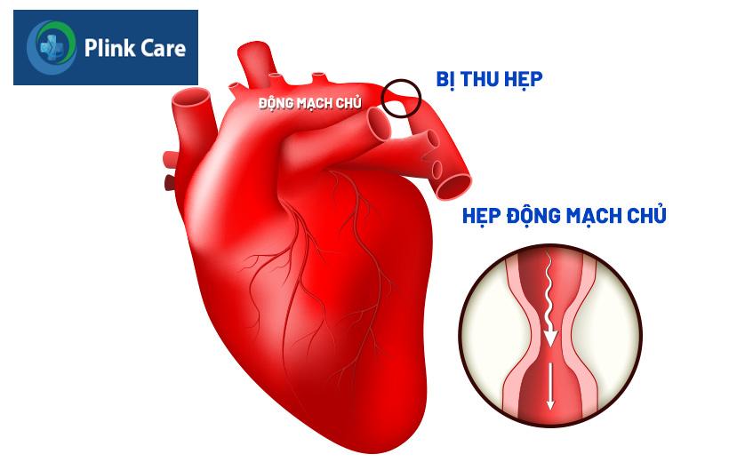 Động mạch chủ bị hẹp eo khiến cho lưu lượng máu từ tim đến các bộ phận giảm