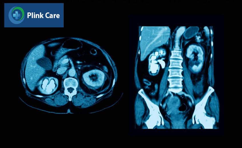 kỹ thuật chụp ct sỏi thận