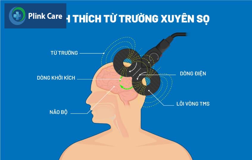 kỹ thuật kích thích từ trường xuyên sọ
