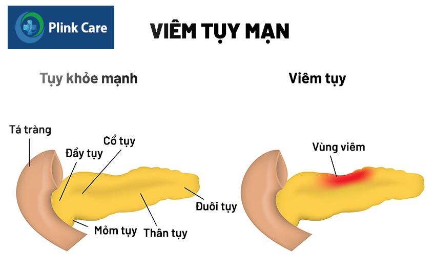 nội soi siêu âm đường tiêu hóa chẩn đoán bệnh gì