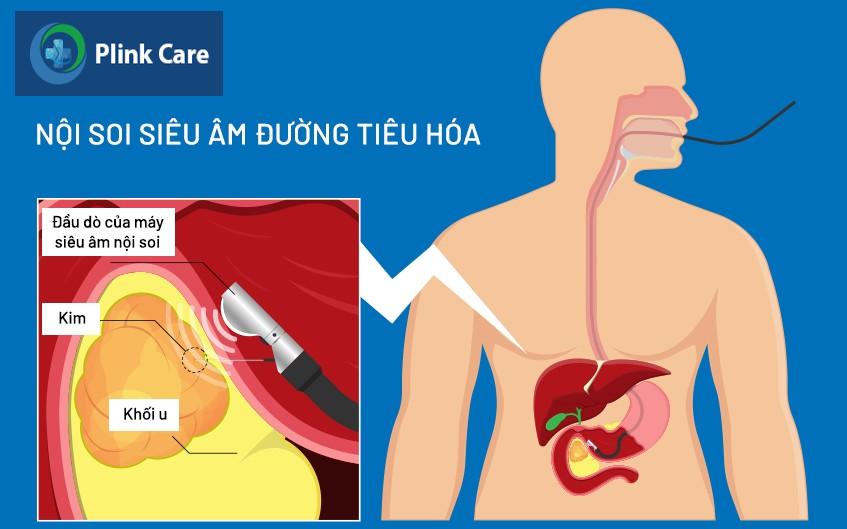 nội soi siêu âm đường tiêu hóa