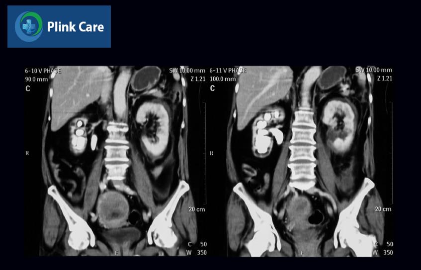 thận ứ nước trên ct scan