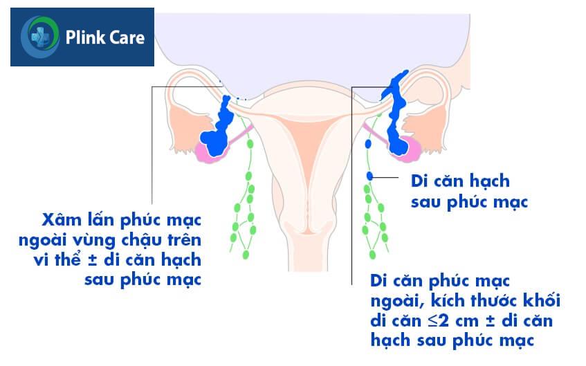 ung thư buồng trứng giai đoạn 3 đã di căn