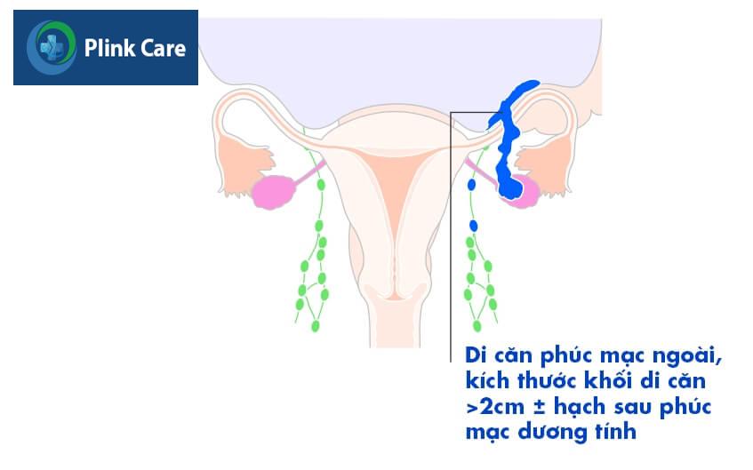 ung thư buồng trứng giai đoạn 3 ung thư buồng trứng giai đoạn 3 di căn