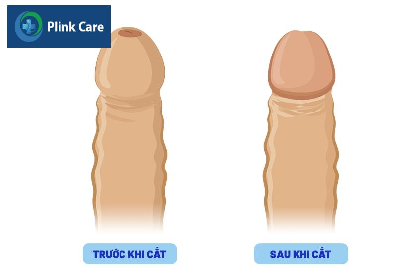 hình ảnh minh họa trước và sau cắt bao quy đầu
