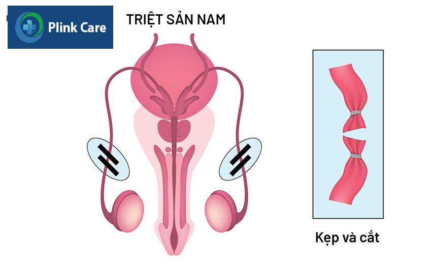 minh họa triệt sản nam