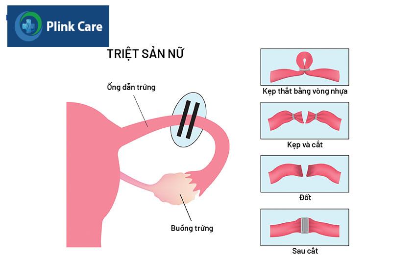 minh họa triệt sản nữ