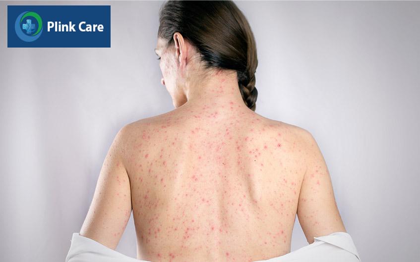 nổi ban đỏ kèm sốt