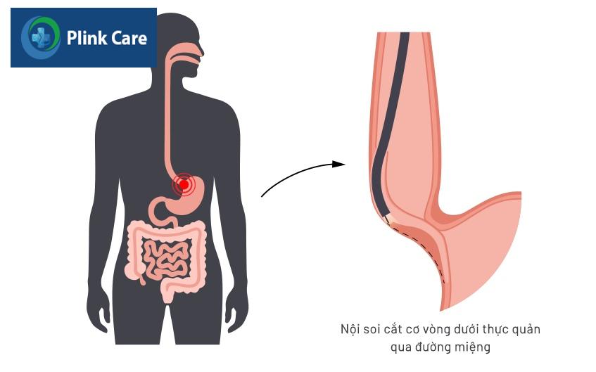 nội soi cắt cơ vòng dưới thực quản