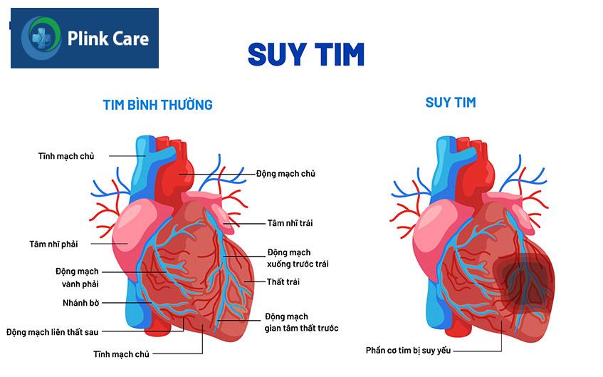 Suy tim là một hội chứng rối loạn chức năng tâm thất