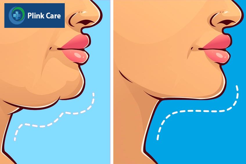 trước và sau khi dùng công nghệ hifu
