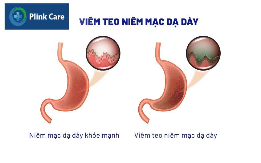viêm teo niêm mạc