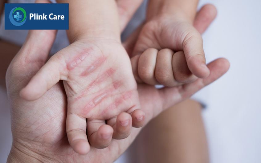 Bàn tay của trẻ bị bỏng