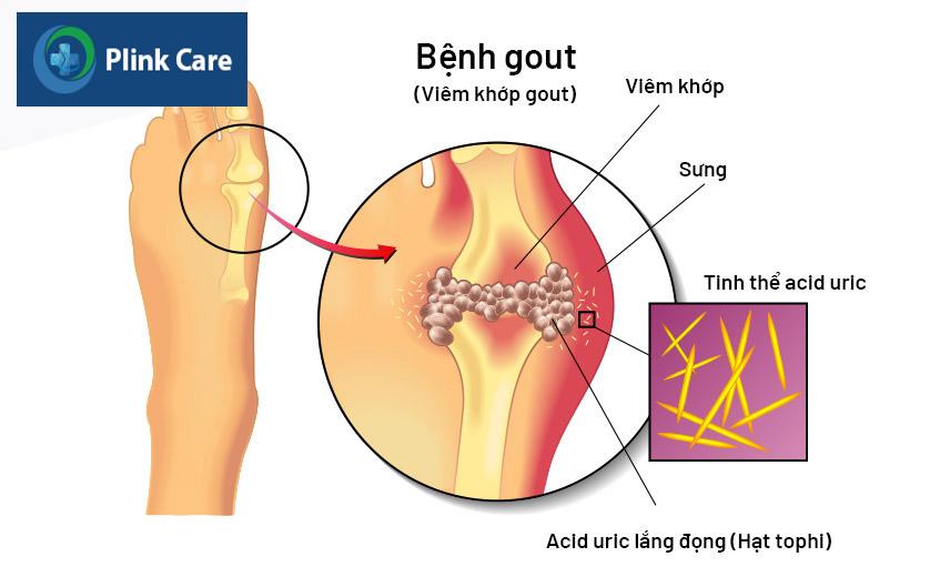 bệnh gây nhiều đau đớn cho người bệnh