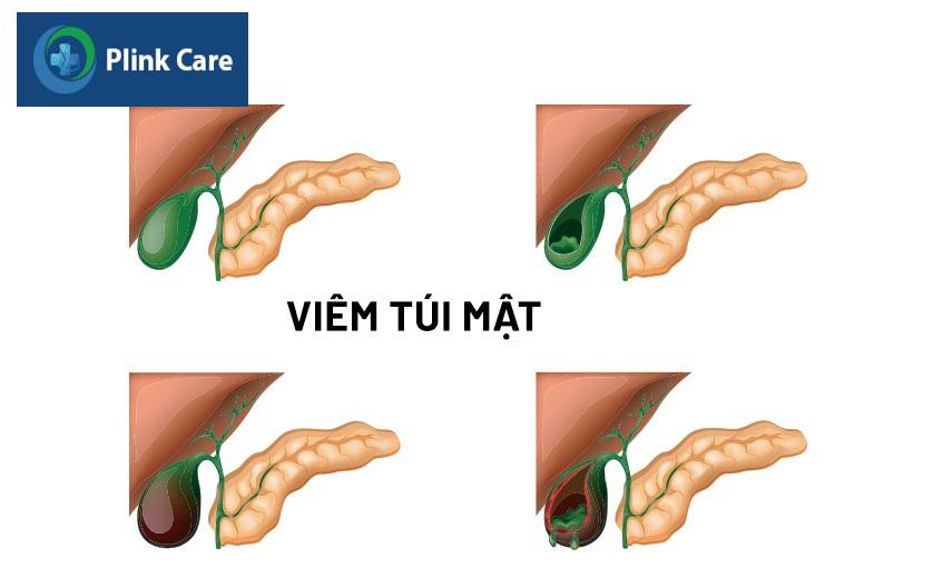 bệnh viêm túi mật