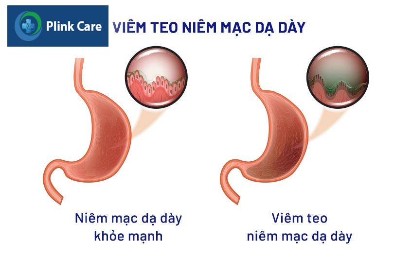 bị viêm teo niêm mạc dạ dày