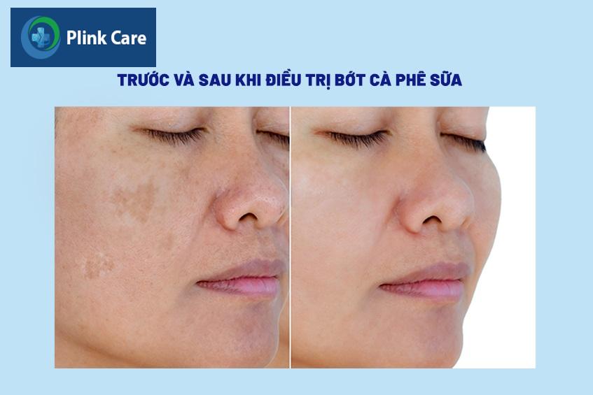 bớt màu cà phê sữa có hại không
