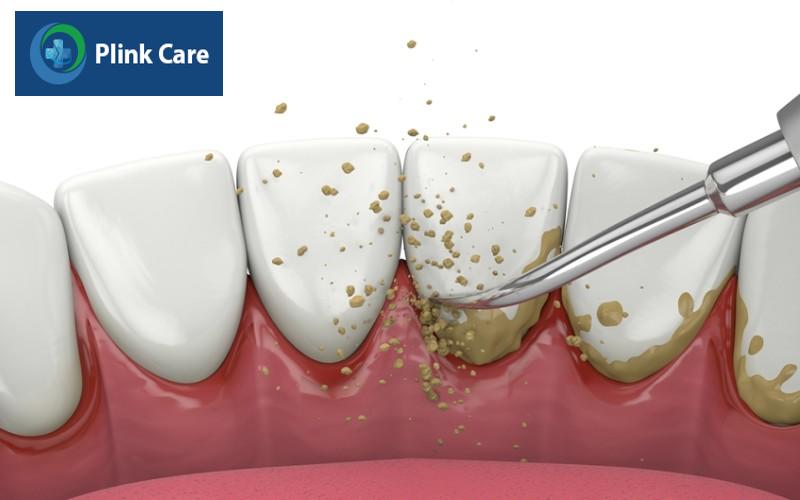 Vì sao nên cạo vôi đánh bóng răng định kỳ?