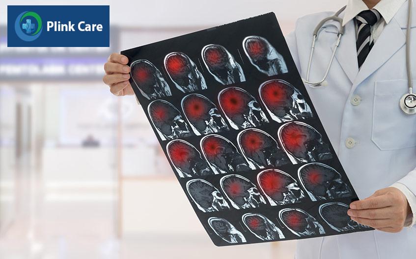 Chụp MRI não có thể chẩn đoán bệnh u sao bào độ 3