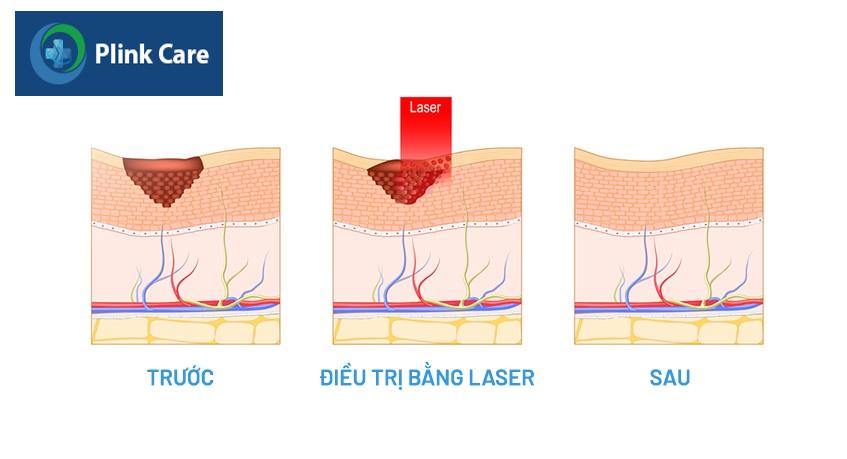 cơ chế điều trị vết bớt bằng laser