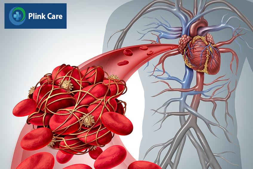 Cục máu đông làm suy giảm, gián đoạn hoặc tắc nghẽn mạch máu