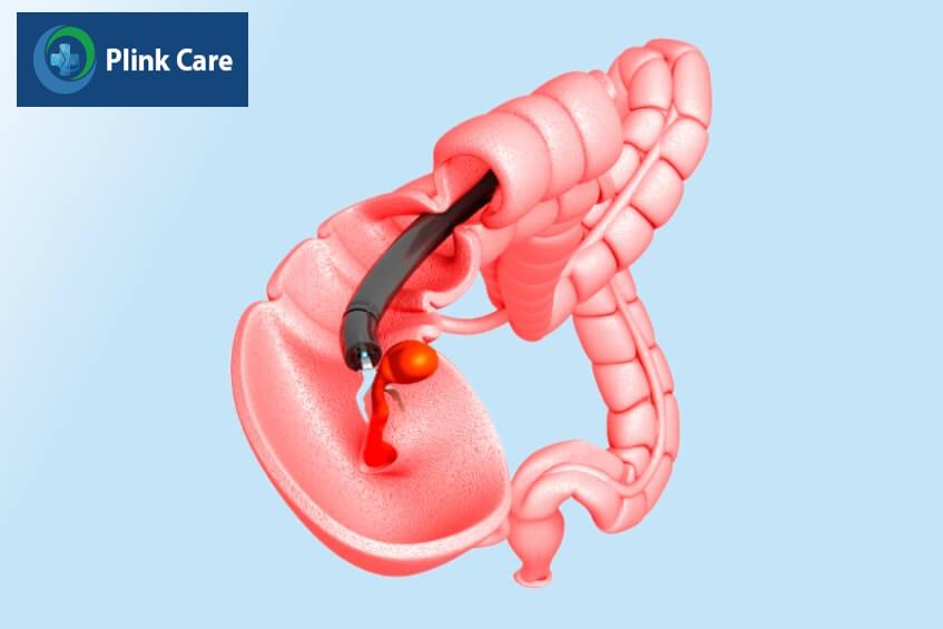 giai đoạn ung thư đại tràng ảnh hưởng điều trị