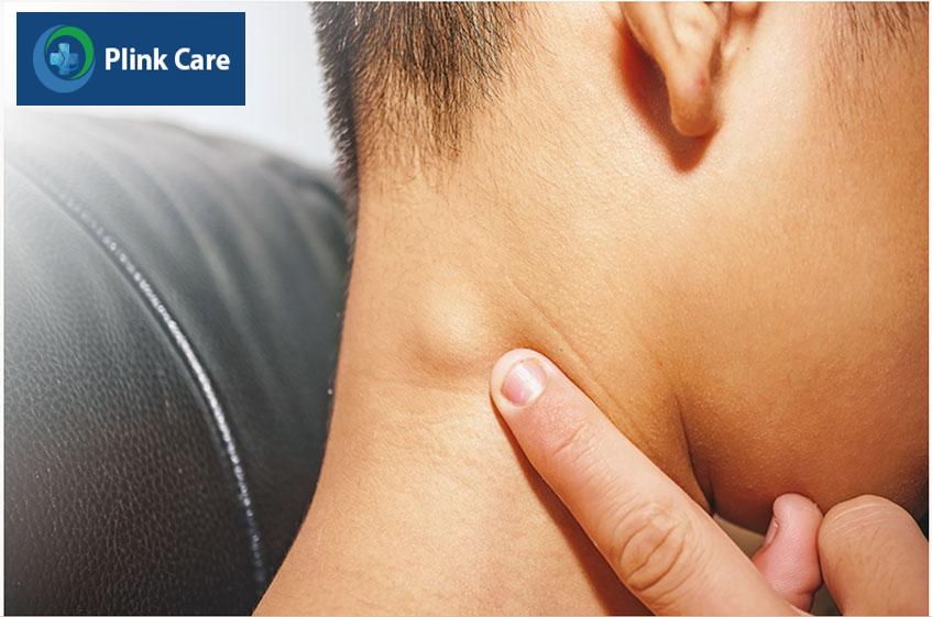 hạch tự biến mất sau khi hết nhiễm trùng