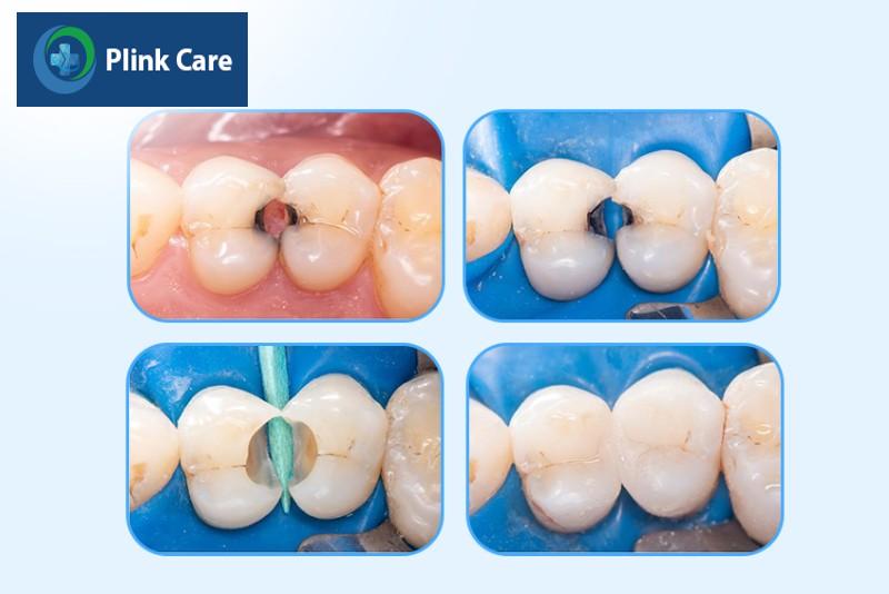 Trám răng thẩm mỹ