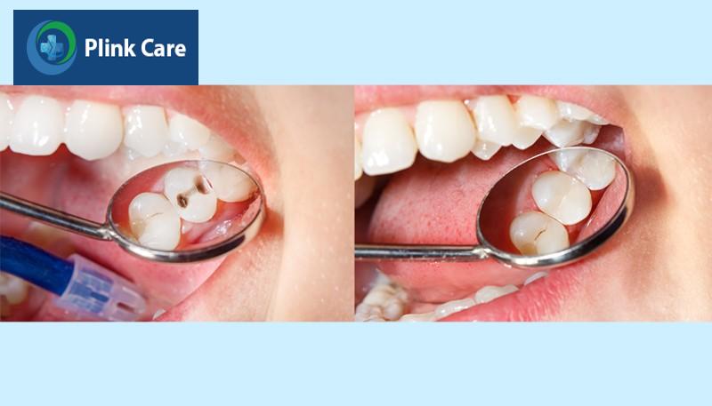 Tại sao răng sâu cần phải trám?
