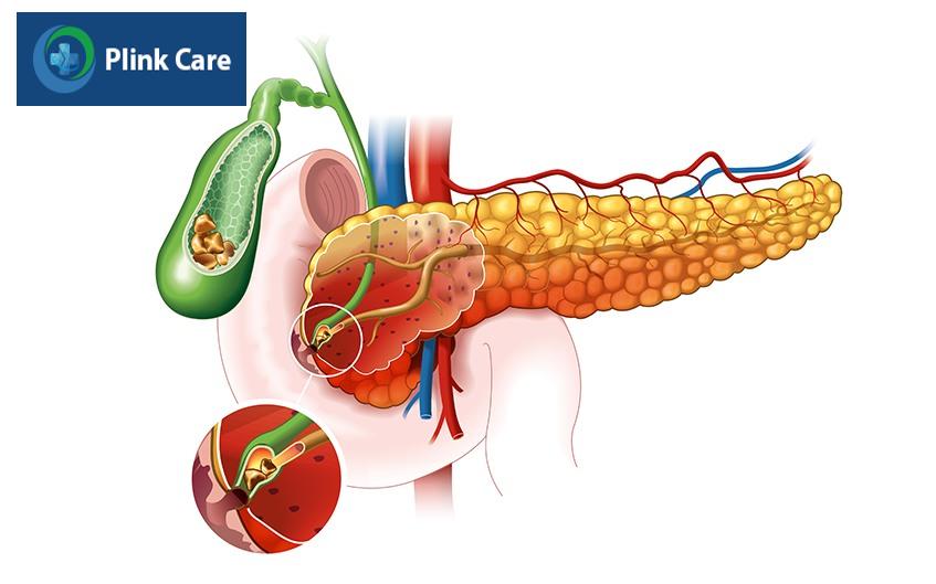 hội chứng tắc mật