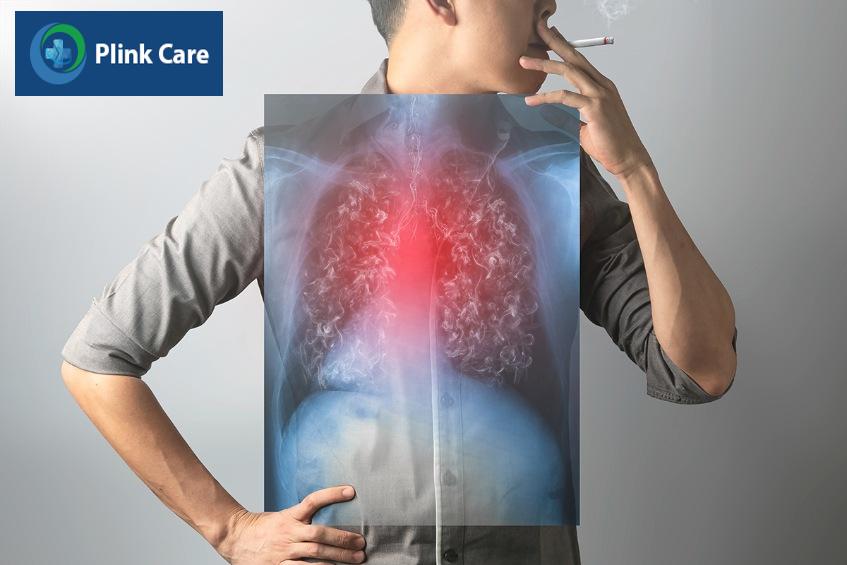 hút thuốc nguyên nhân ung thư phổi tế bào nhỏ