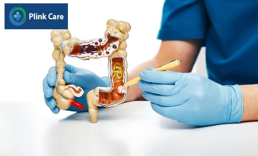 mô phỏng hình dạng ung thư đại tràng