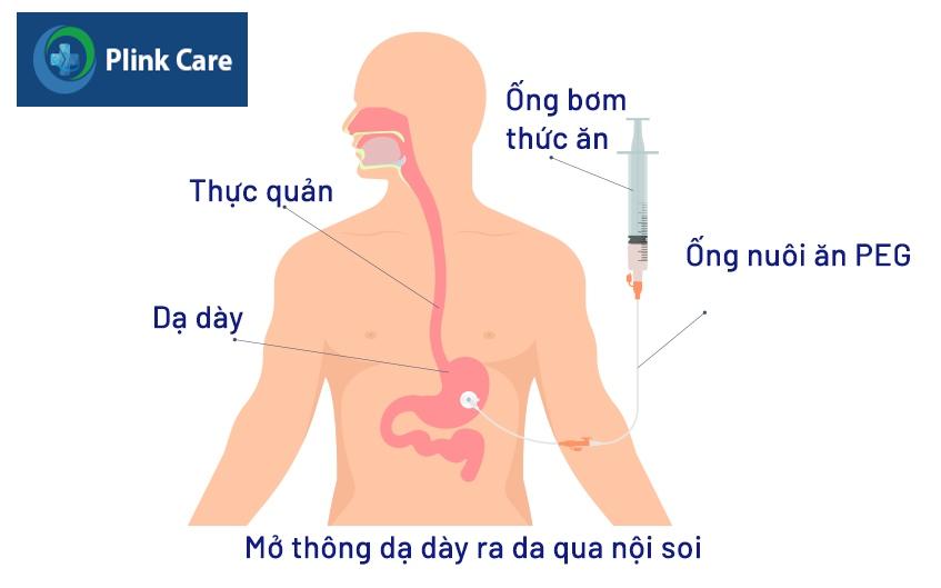 mở thông dạ dày qua nội soi đường miệng