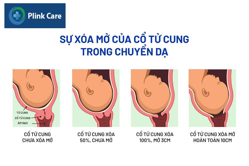 sự xóa mở của cổ tử cung