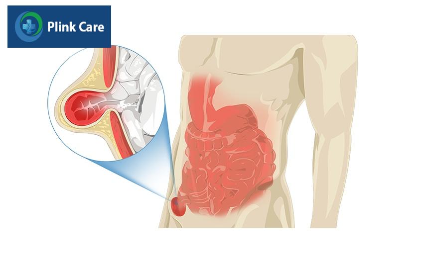 thoát vị bẹn nghẹt là gì