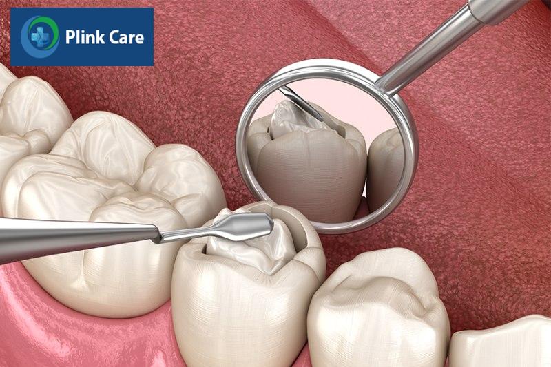 Trám răng sâu có những vật liệu nào? Composite