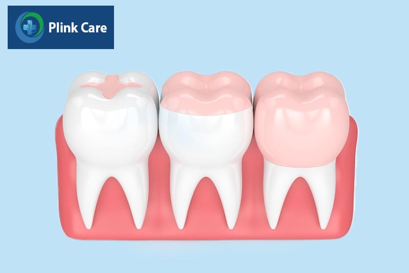 Tại sao phải sử dụng miếng trám răng tạm thời?