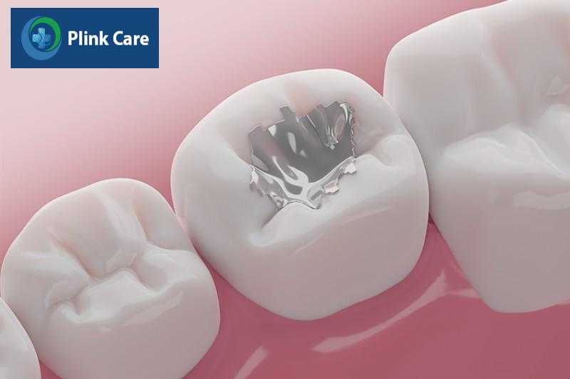 Trám răng sâu có những vật liệu nào? Amalgam