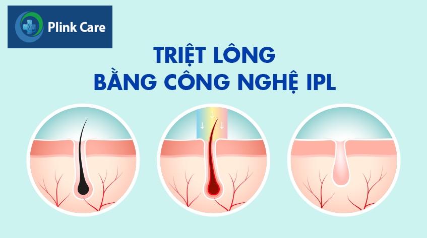 triệt lông bikini có nguy hiểm không