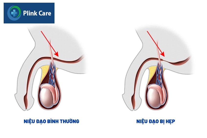 triệu chứng hẹp niệu đạo