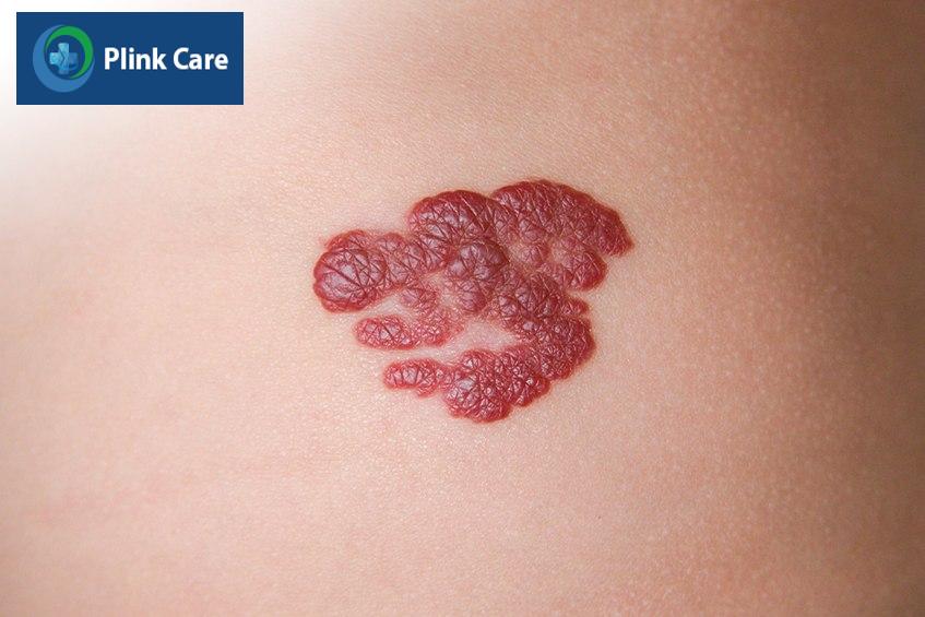 triệu chứng nhận biết vết bớt