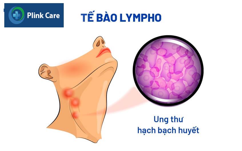 ung thư hạch bạch huyết có được không